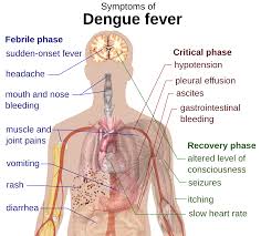 symptoms of dengue fever